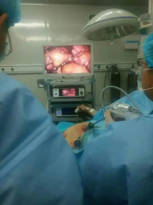 腹腔镜子宫全切除术