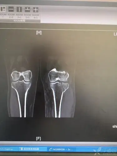 一例胫骨平台带来的思考