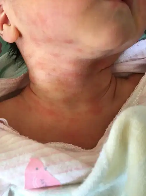 出生不到72小时的新生儿,脖子里长的红疹子,儿科医生说正常,叫新生儿