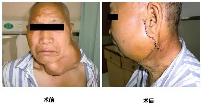 腮腺,颌下腺好发,常以"包块"发现,确诊需手术后病检,良性肿瘤为多数