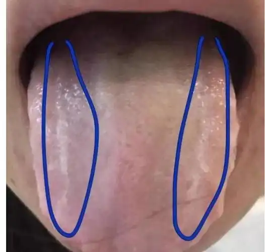 经常舌头有齿印和肿胀 提示你的身体出现了健康危机的"信号"_网易订阅