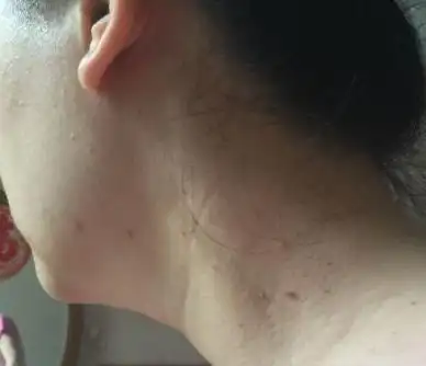 hpv感染是什么提醒皮肤3个异常或要注意可能不是过敏