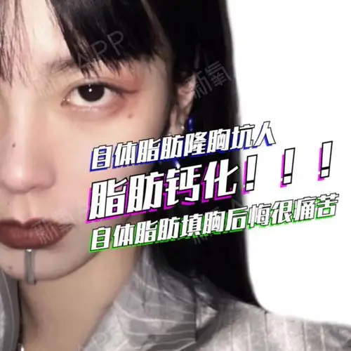 自体脂肪隆胸坑人,自体脂肪填胸后悔很痛苦,脂肪钙化!