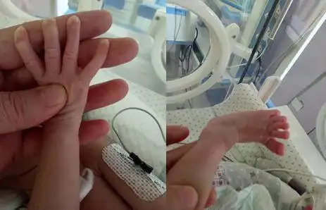 动脉瘤|二尖瓣|马凡|张力|主动脉_网易订阅