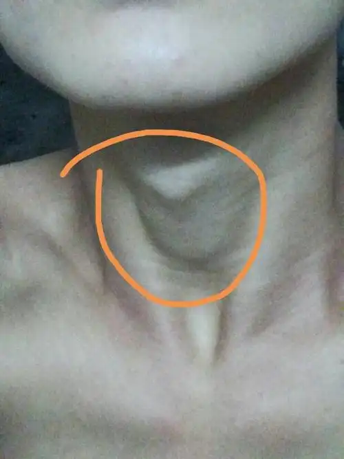 我这个地方怎么会肿起这么大,咽口水不痛,用手去捏就有点痛.