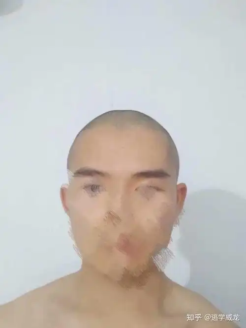 秃顶的男孩应该怎么办?