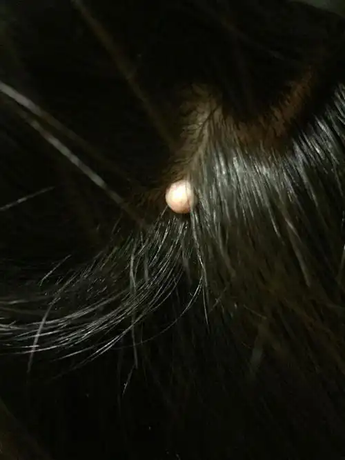 头上长了一个这个不知道是什么东西也不痛不痒?