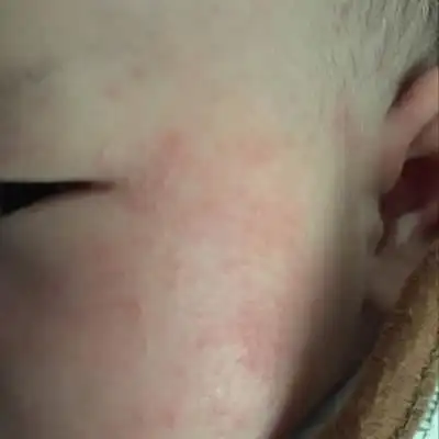 各位宝妈我女儿满脸热疹怎麼办啊……不知道怎麼回