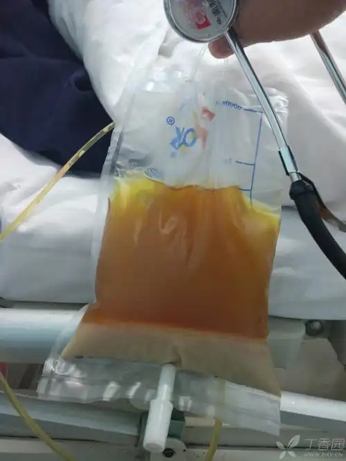 powelwu 脓性胸水 草绿色胸水 粉红色泡沫痰!比教科书还经典!