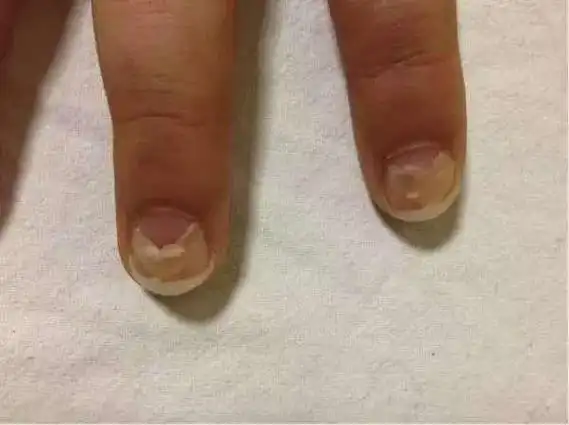 这种情况的指甲脱落不要乱补东西