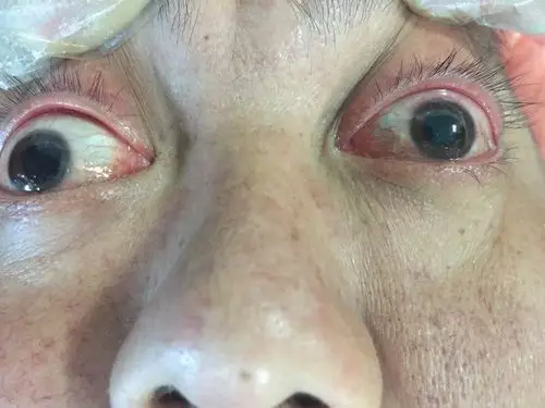 双侧瞳孔散大,提示脑疝晚期