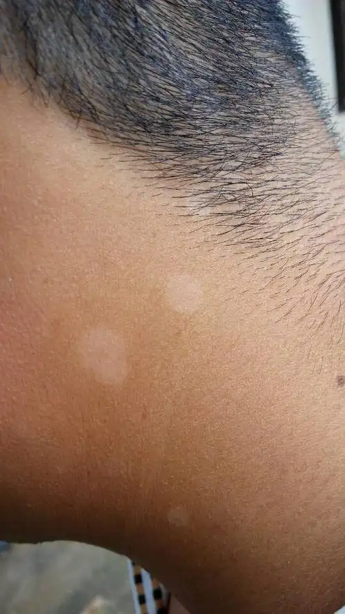 老公今年去的非洲,最近发现脖子后面有几个白点,不痛