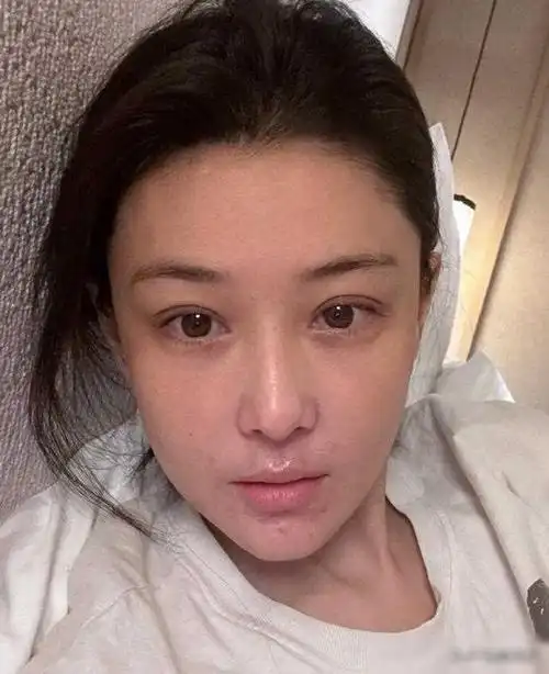 张馨予分享素颜近照,皮炎复发面部出现疤痕,透露爆发期很吓人!