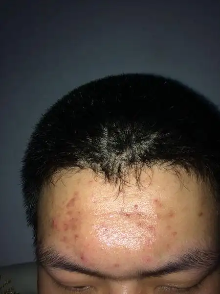 二十岁.额头一直长痘.现在吃药中药调理了没长逗了.但是有很多痘印.