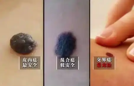 哪些部位的痣容易发生癌变?