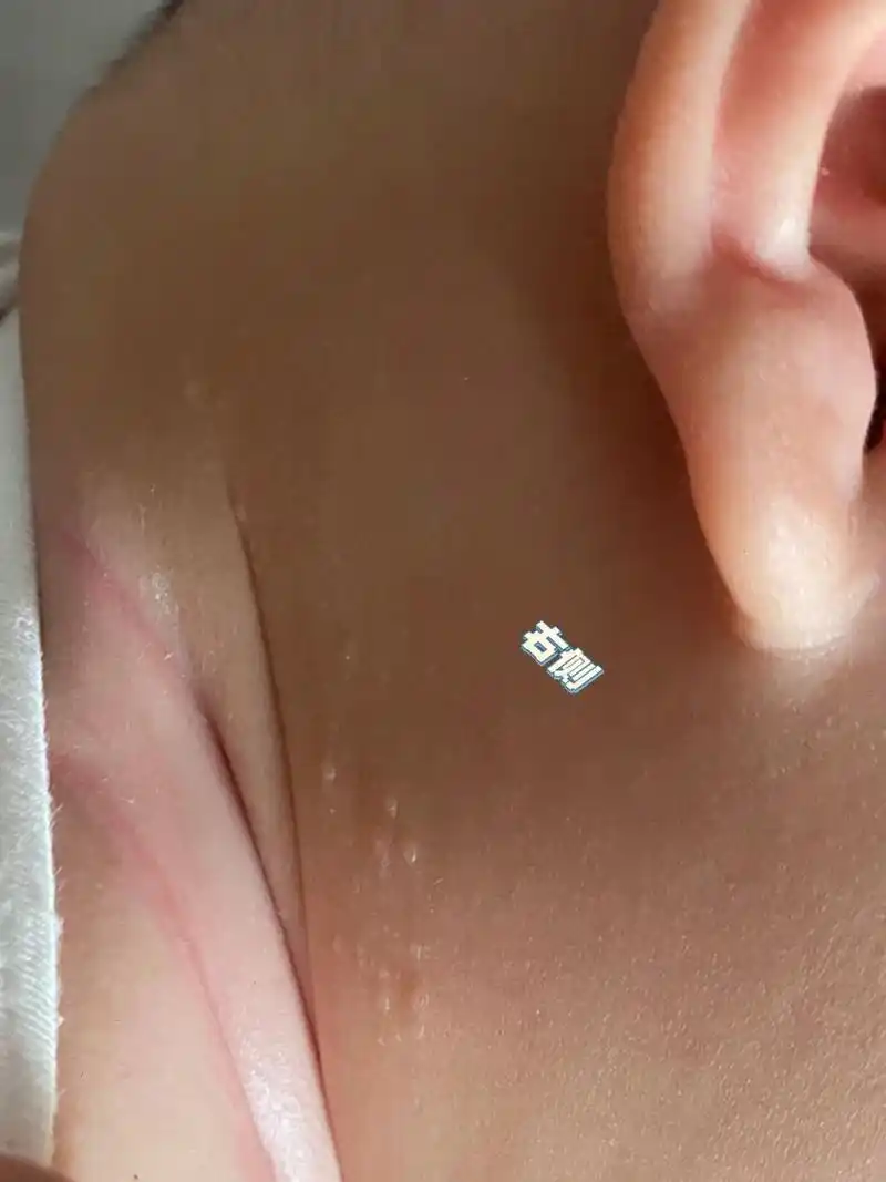 宝宝湿疹,汗斑克星 98葫芦周三左侧脖子处有湿疹,抹了点氧化锌软膏