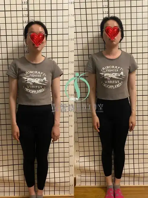 圆肩驼背头前引,体态不正,影响整体气质,不驼背了也长高了#产后康复