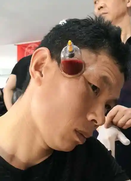 偏头痛 失眠 三叉神经痛 拔罐放血疗法有奇效