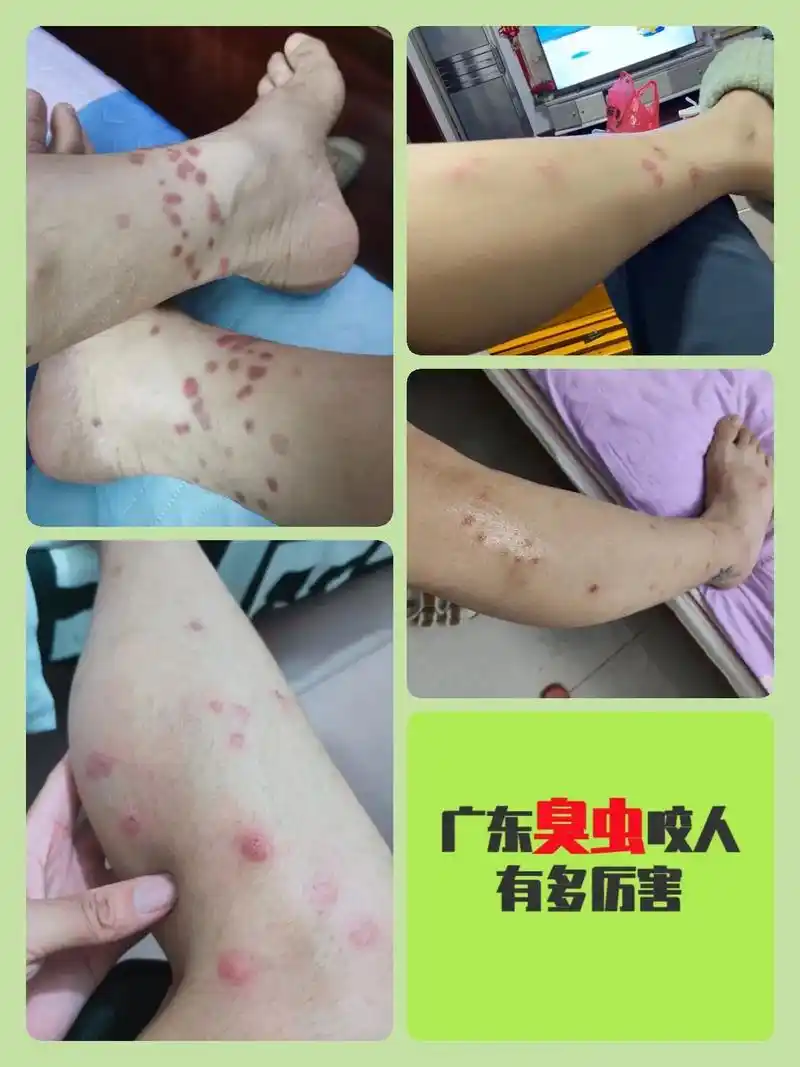 臭虫咬人的症状.臭虫一般过群居生活,并可随衣物,行李寄居,主 - 抖音