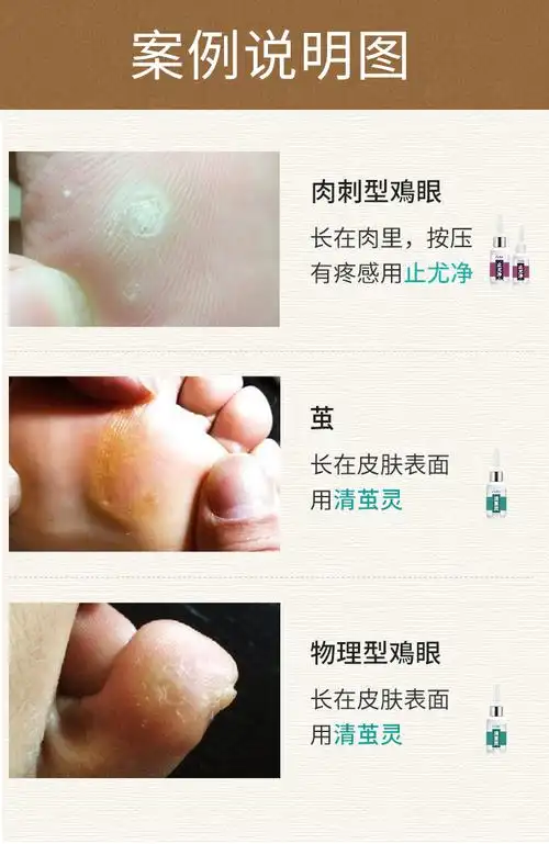 清茧灵去疣膏鸡眼膏液肉刺去除脚上长疣立净疣瘊刺猴去老茧脚茧子