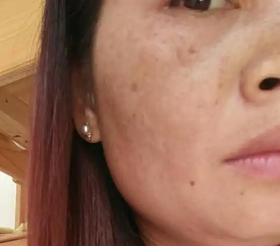 此时,便会出现黄褐斑,也称为肝斑. 这黄褐斑的