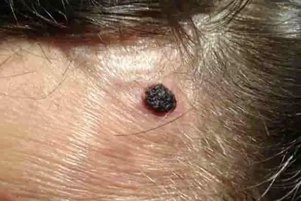 容易癌变的黑痣图片6