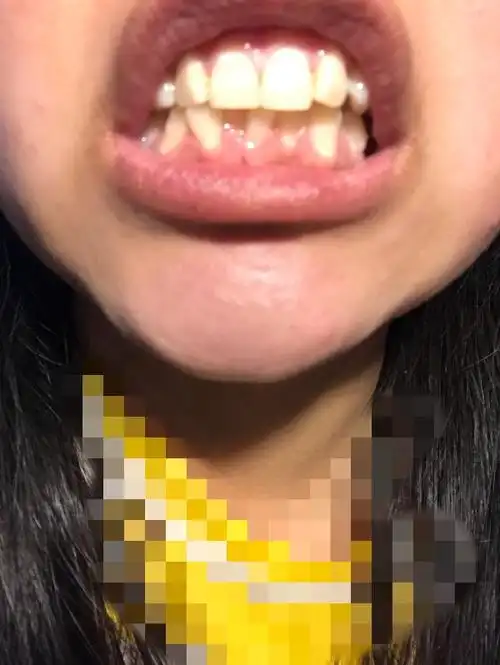 大小脸,嘴歪,牙齿不齐,可以通过整牙来解决吗.