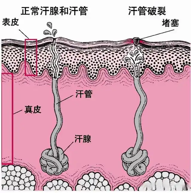 屁股总是起疮?小心肛周化脓性汗腺炎