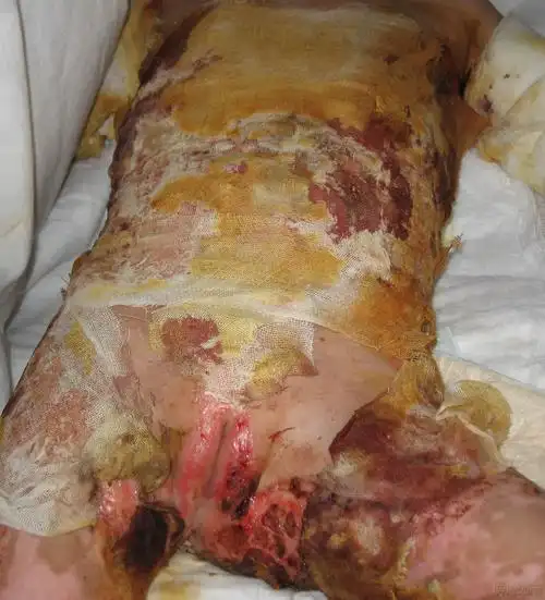 沸水烫伤病例讨论