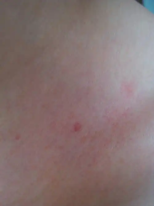 锁骨这红斑块是怎么回事丫?