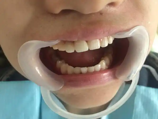 牙齿中线偏斜,求矫正. - 好大夫在线