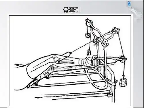 牵引术后的护理要点