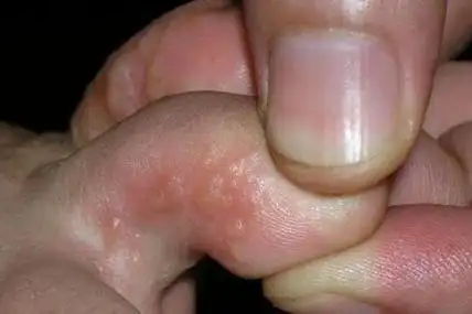 这也就是我们常说的:水泡型脚气真菌感染:就像是我们脚部被真菌感染后