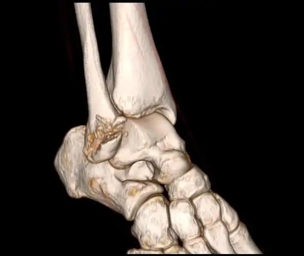 腓骨骨折需要手术吗