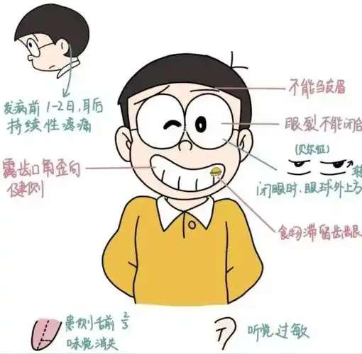 【健康科普】关于面神经炎