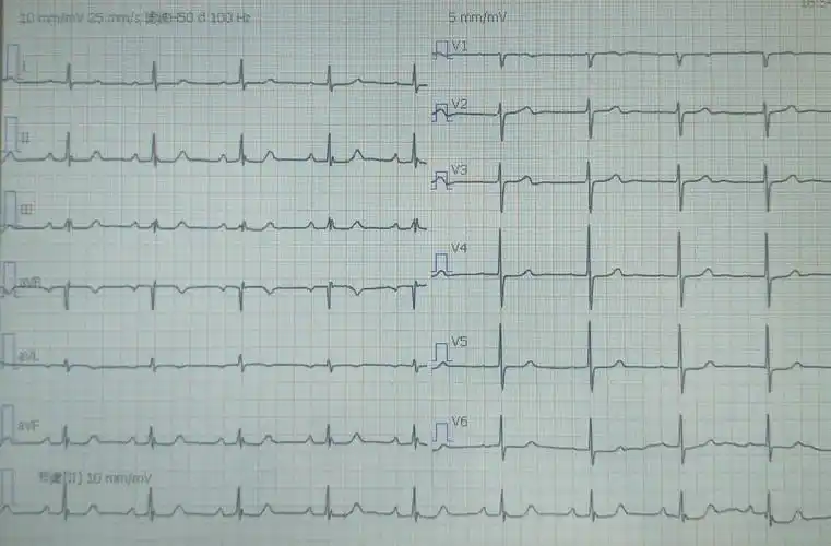 ravl>ri,电轴左偏 -45° 女,60y,风湿性心脏病(二尖瓣关闭不全合并下
