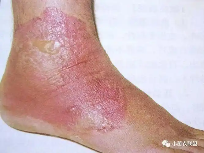 湿疹_介绍_发病原因_症状表现_治疗方式 - 好大夫在线