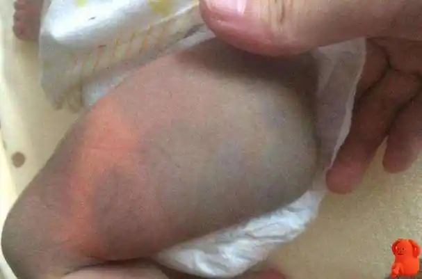 有胎记的孩子是什么投胎来的