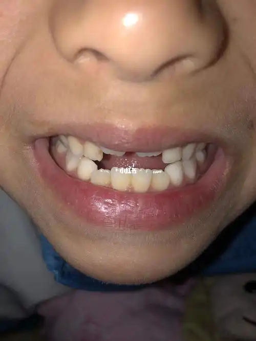 地包天戴牙套40天