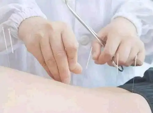 >> 文章内容 >> 针刺与药物治疗女性更年期失眠症30例 针刺麻醉的针药