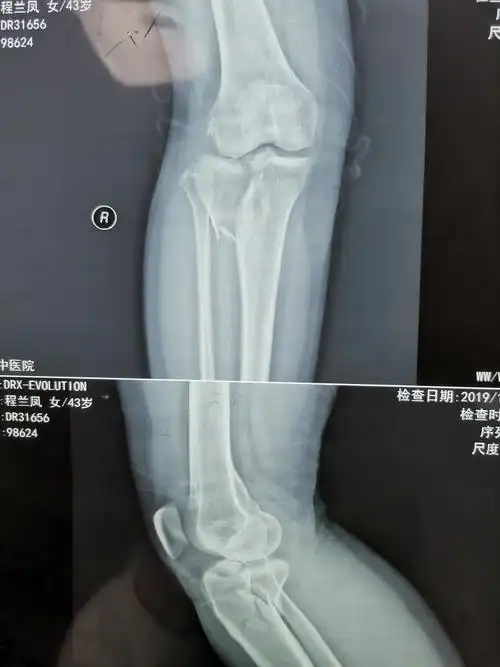 一例胫骨平台骨折的全过程