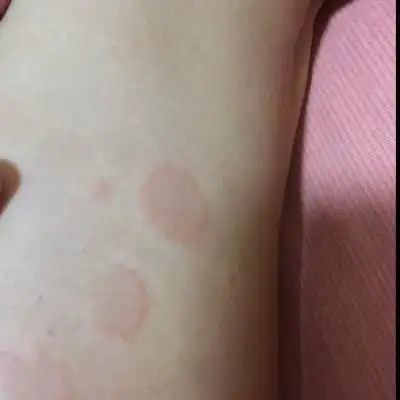 问答 怀孕期 推荐回答                      皮癣,我之前也有过,涂