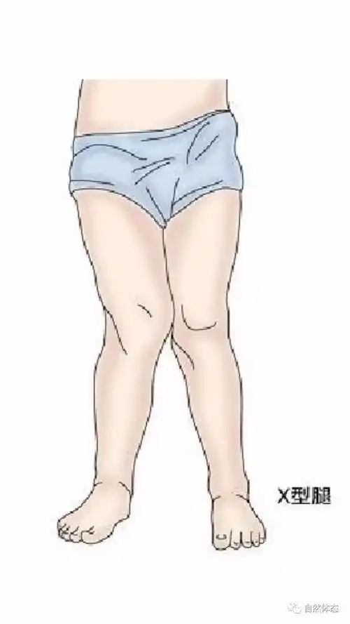 什么是xo型腿