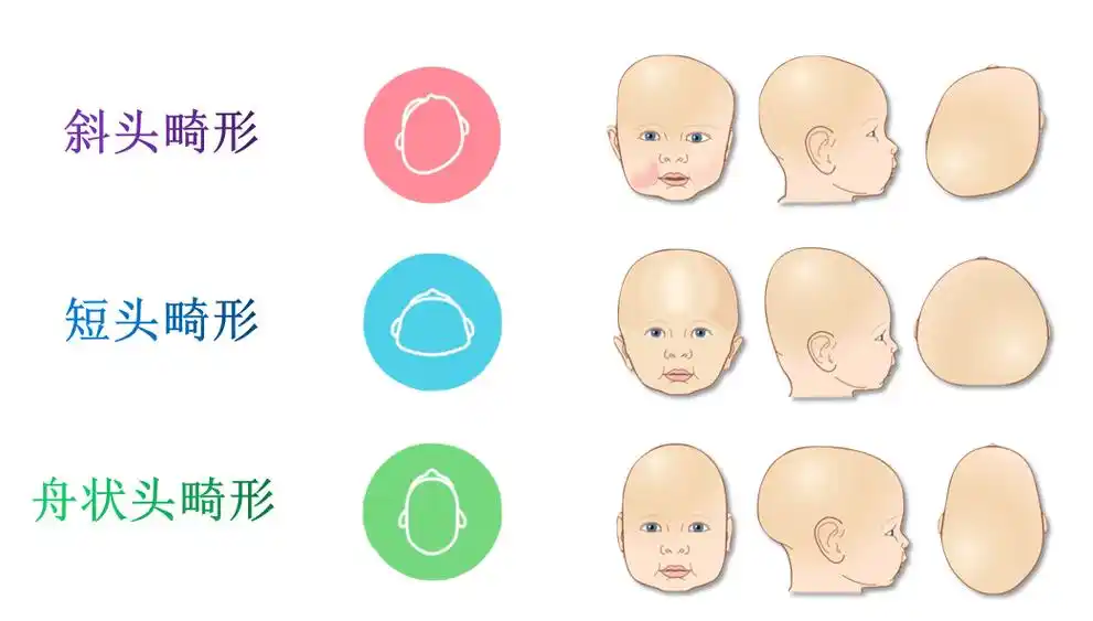 婴儿头颅畸形概念及分类