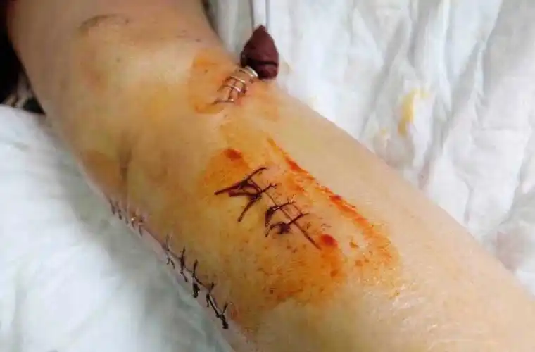 河南美女主播被宝马车撞伤 3名醉酒男子逃逸