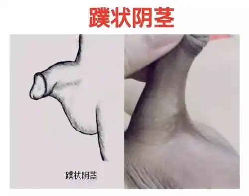 保护好小鸟:勿把"蹼状阴茎""隐匿型阴茎"误认为简