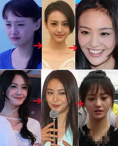 郑爽整容前后【相关词_郑爽整容前后照片对比】