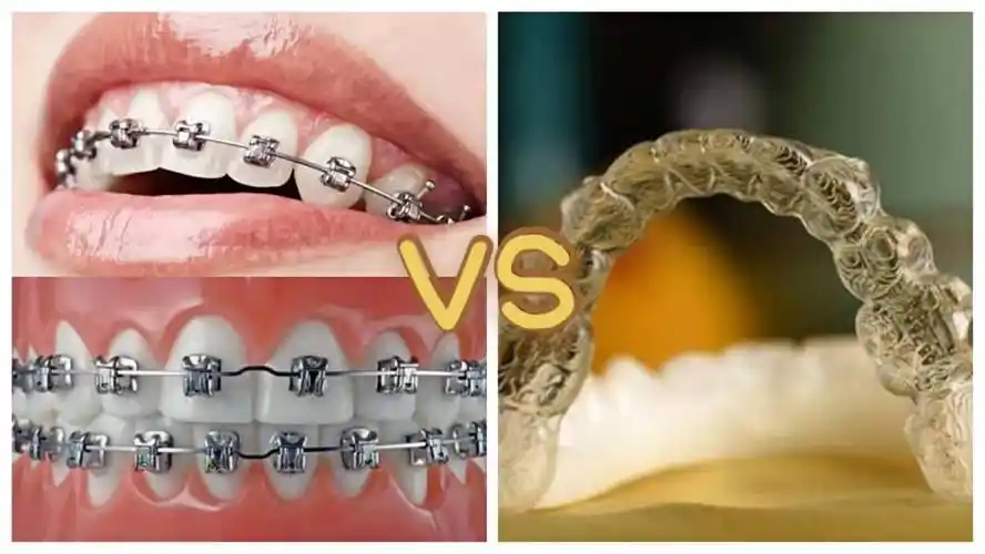 南京牙齿矫正正畸哪家比较靠谱金属牙套和隐形牙套有什么区别