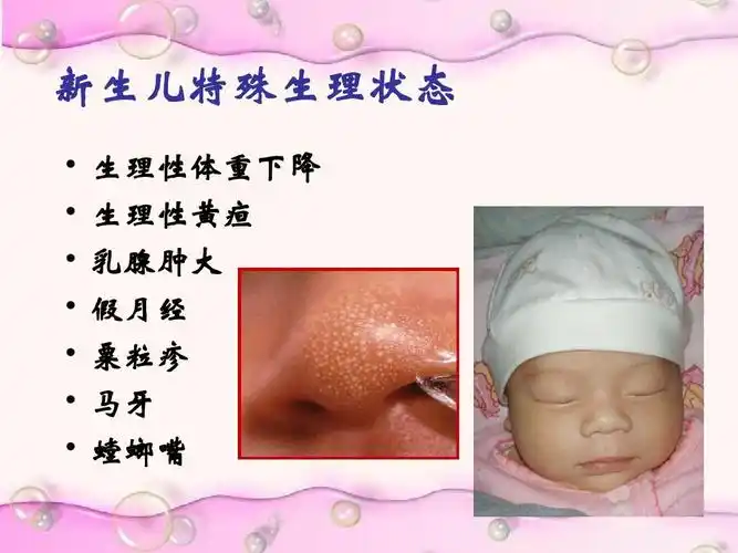 生理性体重下降 生理性黄疸 乳腺肿大 假月经 粟粒疹 马牙 螳螂嘴