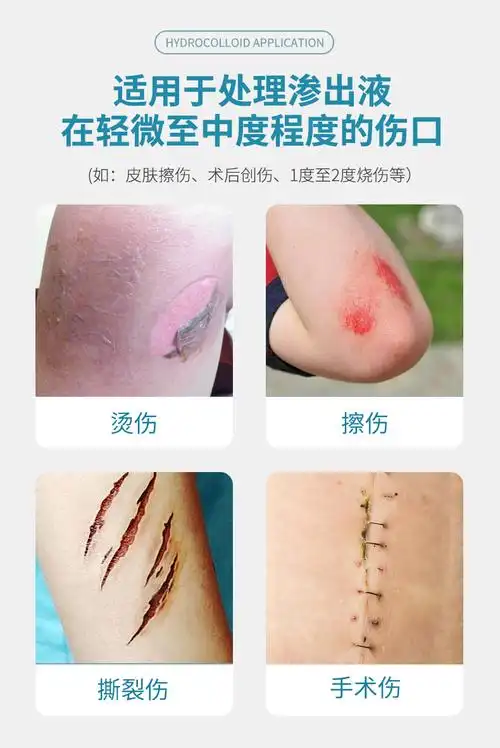 医用水胶体敷贴康乐宝透明贴康惠尔 术后愈合贴伤口贴水凝胶伤口敷料